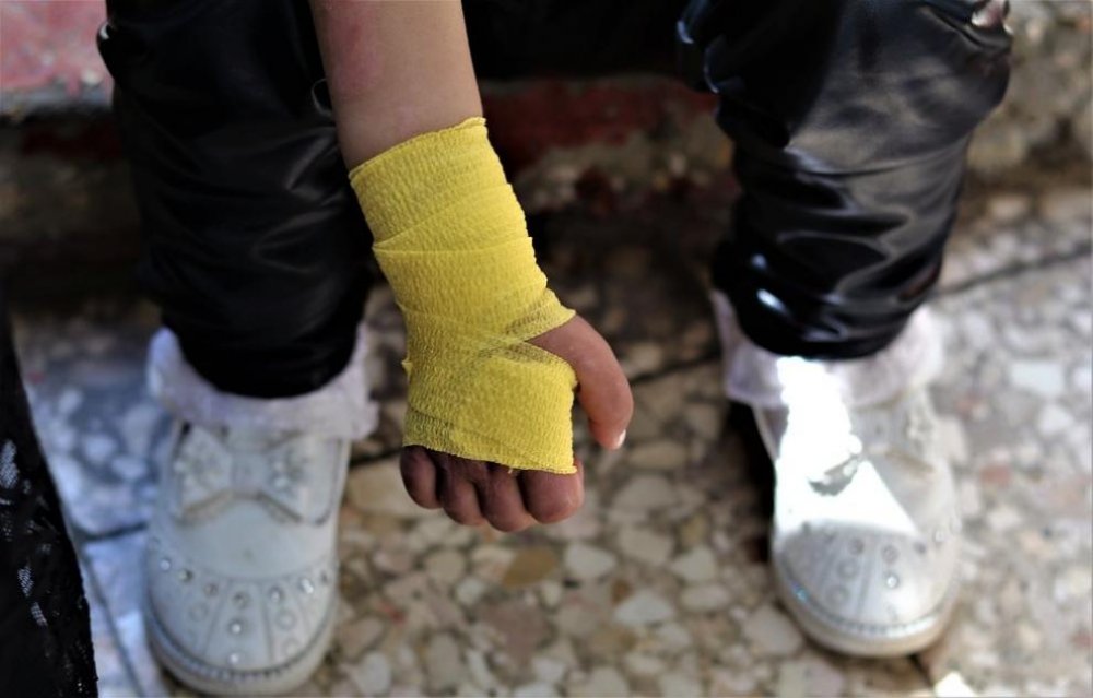 2.5-year-old Jana receives treatment in MSF’s trauma and burn clinic in Gaza.
