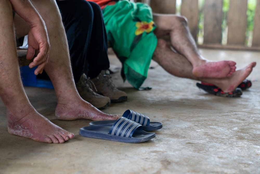 One of the most common conditions presented by migrants arriving at Bajo Chiquito, the first town after crossing the Darién, is damage to their feet after days walking in a tropical rainforest. (June, 2021).