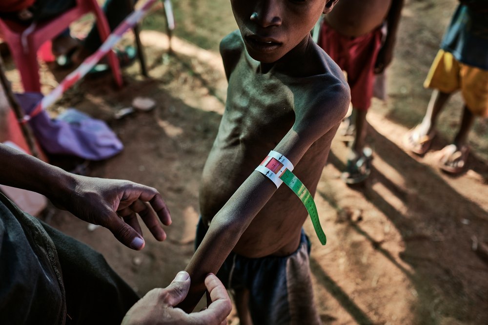 People in the south-east of Madagascar are facing the most acute nutritional and food crisis the region has seen in recent years. The MUAC (Mid-Upper Arm Circumference) is a quick way of identifying children at risk of malnutrition.