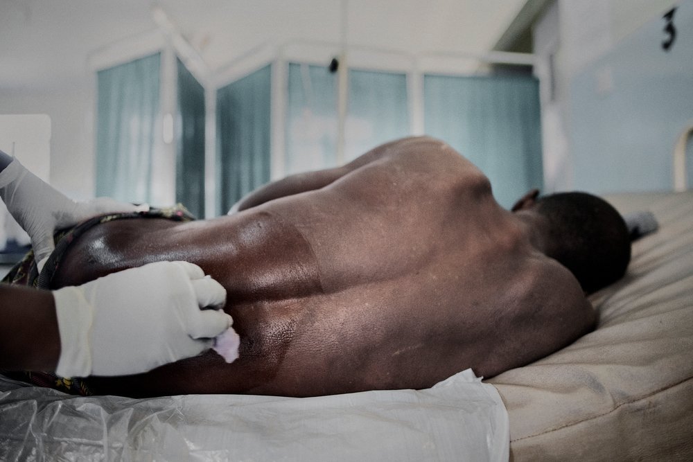 Emmanuel Frances, 39 years from Nsamera Mozambique has advanced HIV and related opportunistic infections cryptococcal meningitis and TB. Malawi, 2017. 