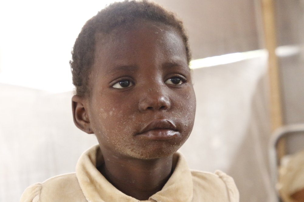 9-year-old Obulu Solange is being treated for measles at the Bosobolo General Referral Hospital. “I brought her here for proper care as she had redness in her eyes and rashes”, says her mother Onie.