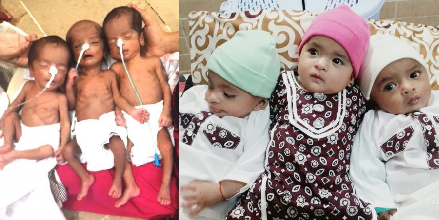 Tufail's triplets Haniya, Iftikhar and Taha at birth and at one year old.